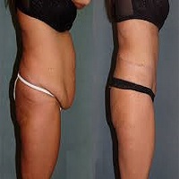 body contouring without surgery