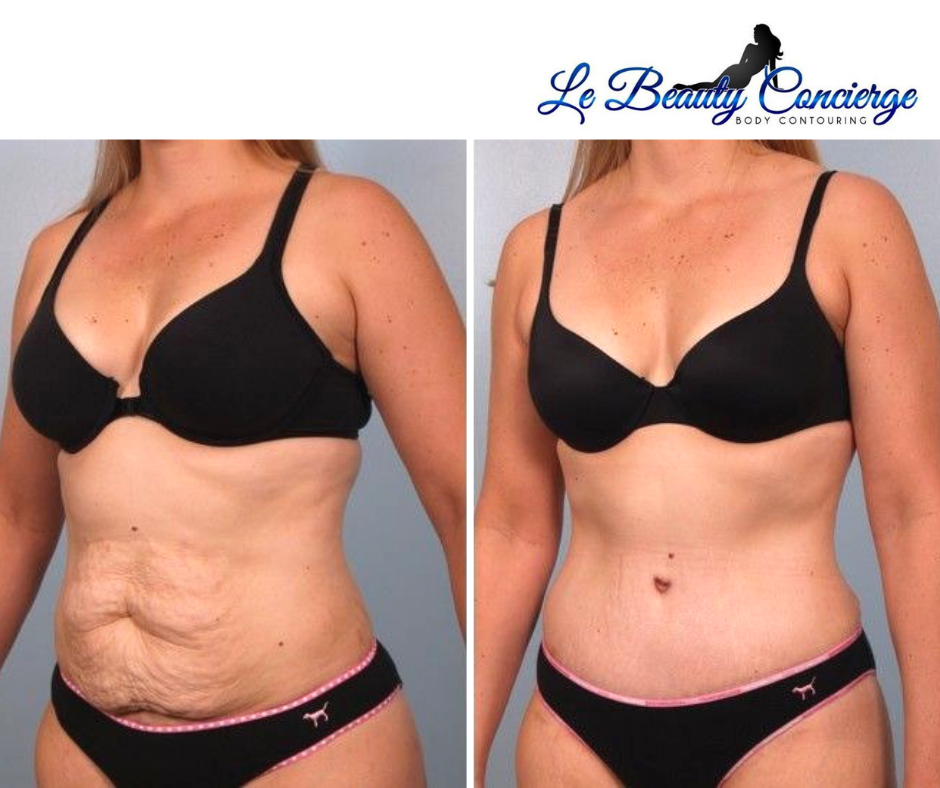 Body Contouring surgery in Houston