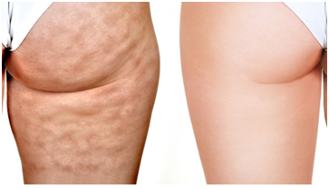 best treatment for cellulite on legs